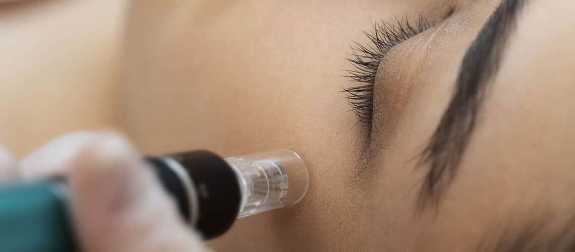 Microneedling facial